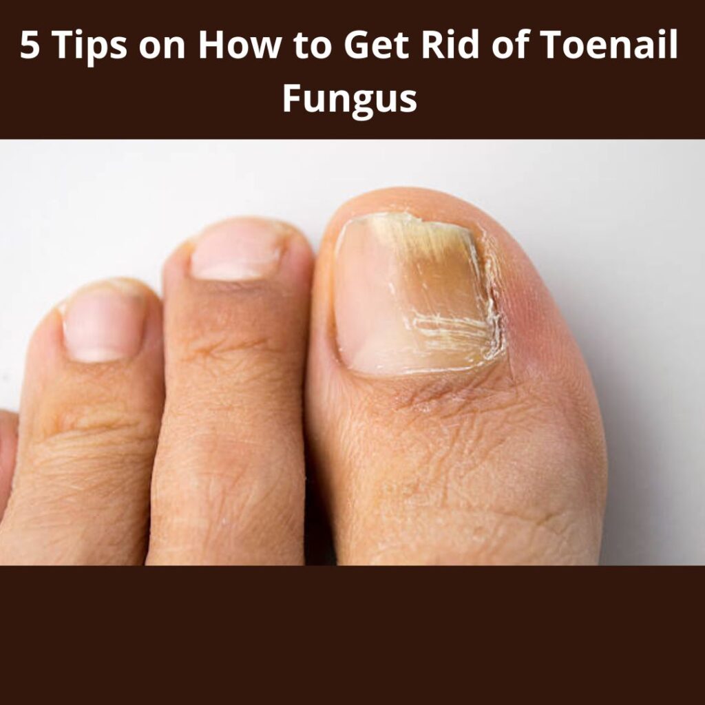 How to Get Rid of Toenail Fungus: Effective Strategies and Solutions