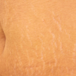 Can Stretch Marks Disappear?