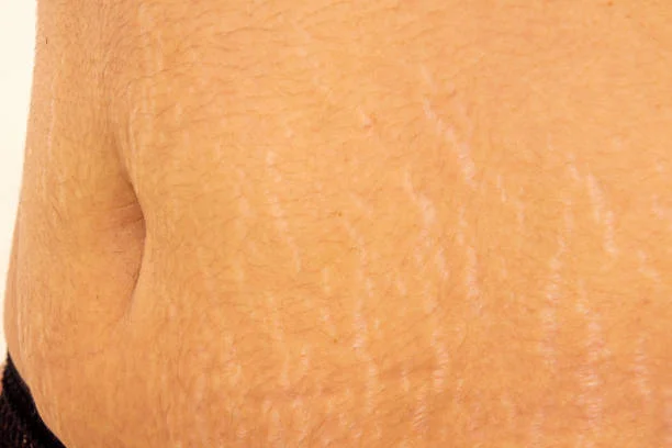 Can Stretch Marks Disappear?